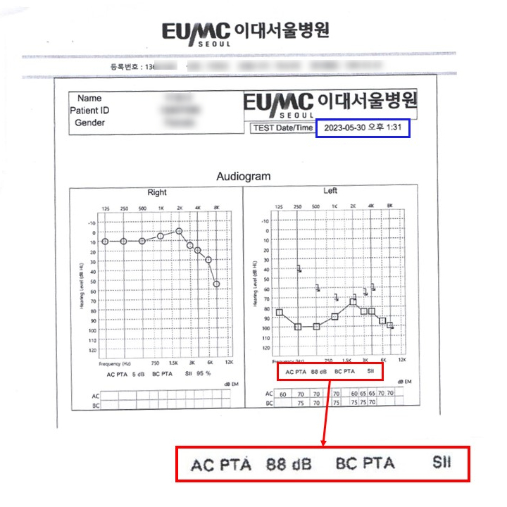 돌발성 난청 골든타임, 3개월 지나도 좋아질 수 있나요?