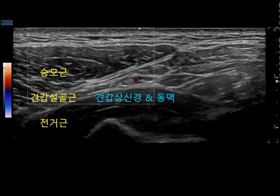 어깨 부위의 승모근, 견갑설골근, 전거근과 견갑상신경 및 동맥을 보여주는 초음파 영상