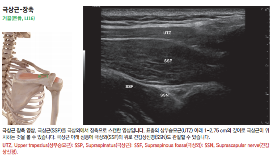 어깨 극상근의 해부학적 위치를 보여주는 골격 그림과 극상근, 상부승모근, 극상와, 견갑상신경을 표시한 어깨 초음파 영상.