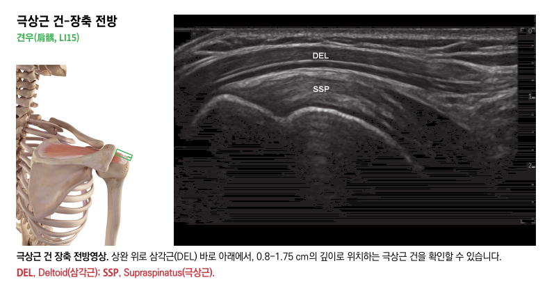 어깨의 극상근 해부학적 그림과 극상근 건 및 삼각근이 보이는 어깨 초음파 영상.