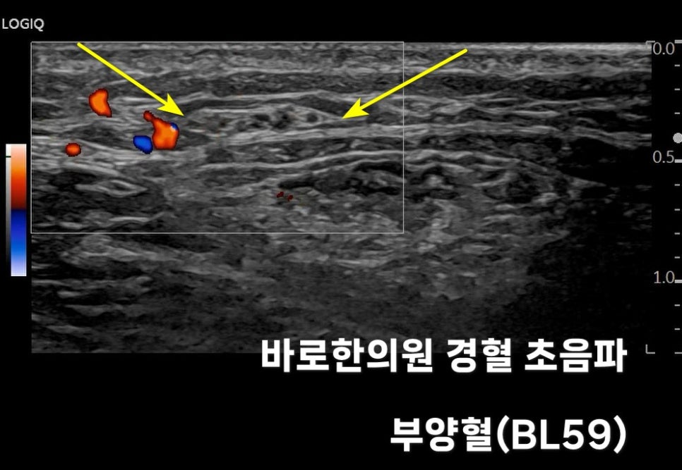 노란색 화살표가 혈류와 주변 조직을 가리키는 부양혈(BL59) 부위의 초음파 사진.