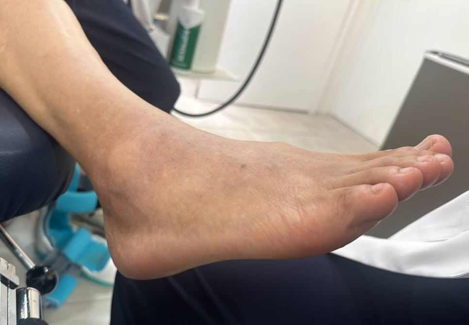 발목과 발이 부어 있고 피부에 변색이 있는 모습