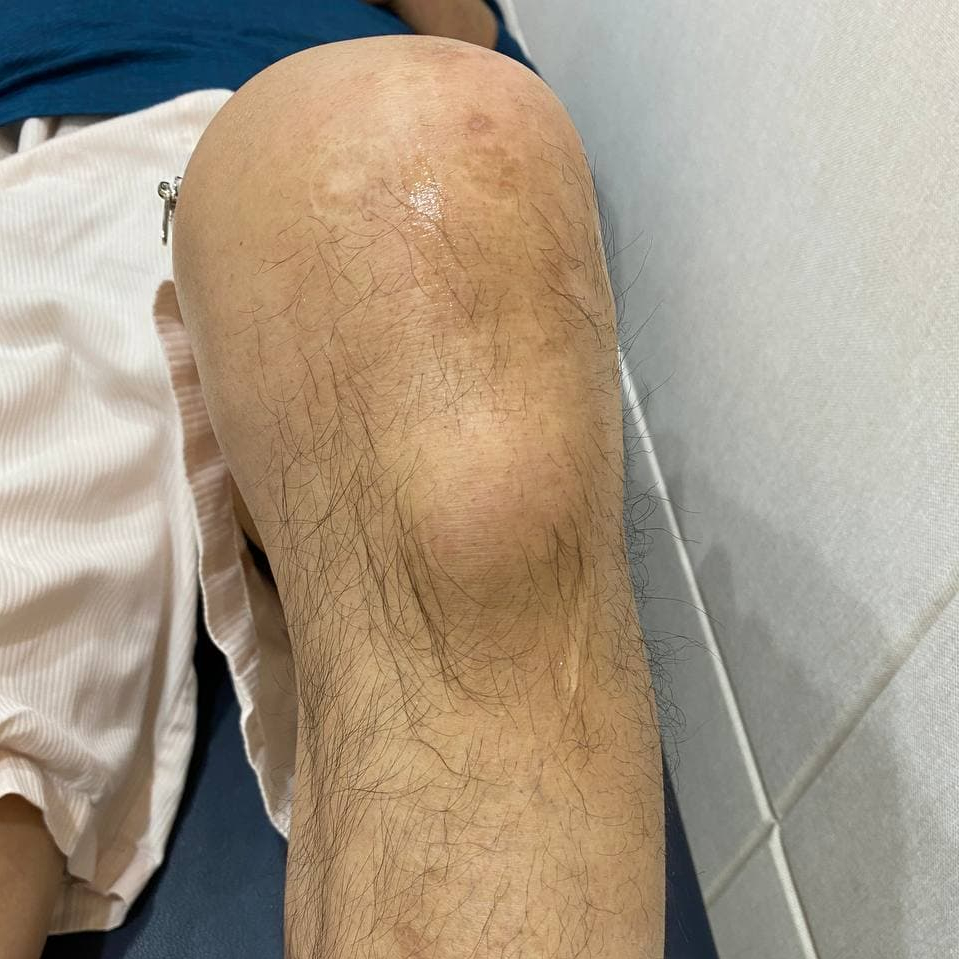 털이 있는 무릎에 부기가 있는 모습