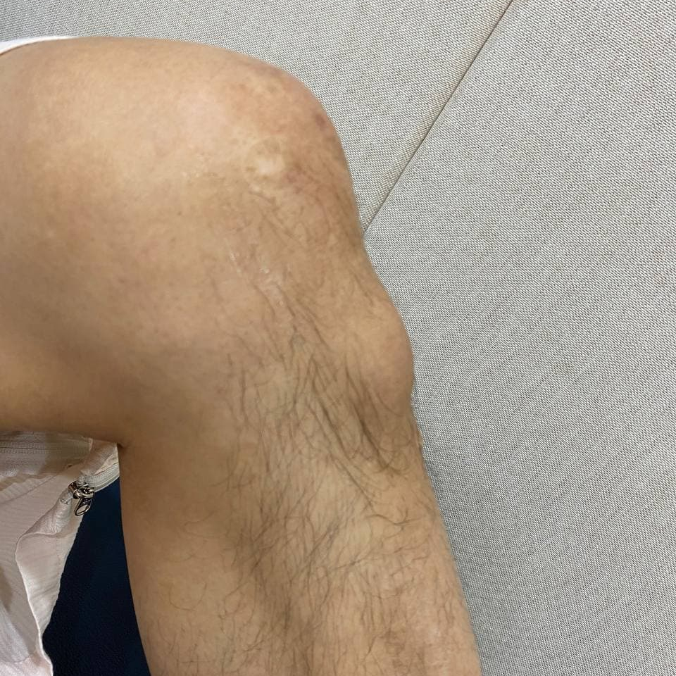무릎 앞쪽에 부기가 있는 다리 사진