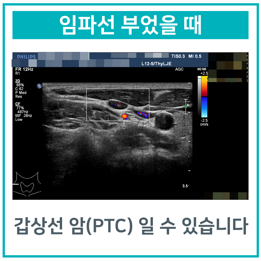 목 부위의 초음파 사진으로, 혈류가 보이는 임파선 또는 갑상선 조직이 보인다.