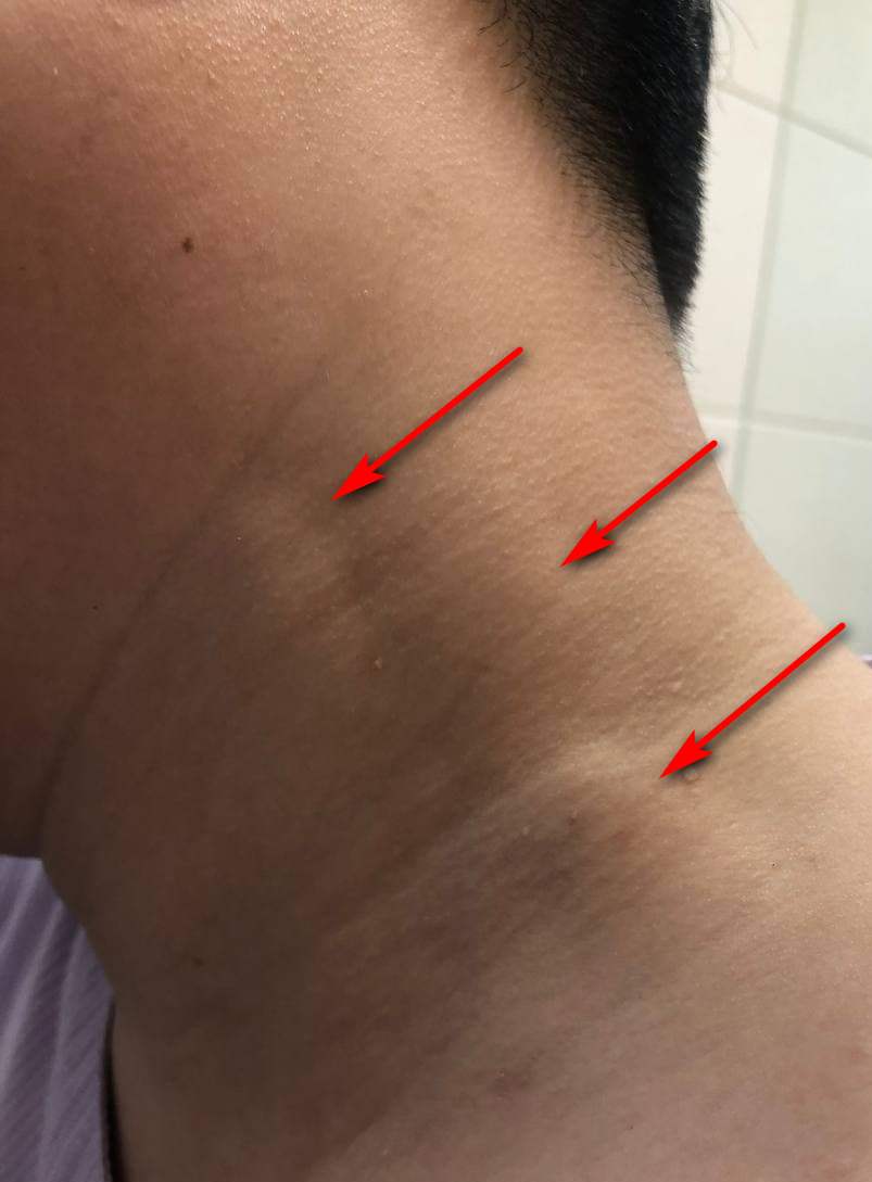 목 옆 피부 아래에 부어 보이는 멍울 세 개를 빨간 화살표가 가리키고 있는 모습.