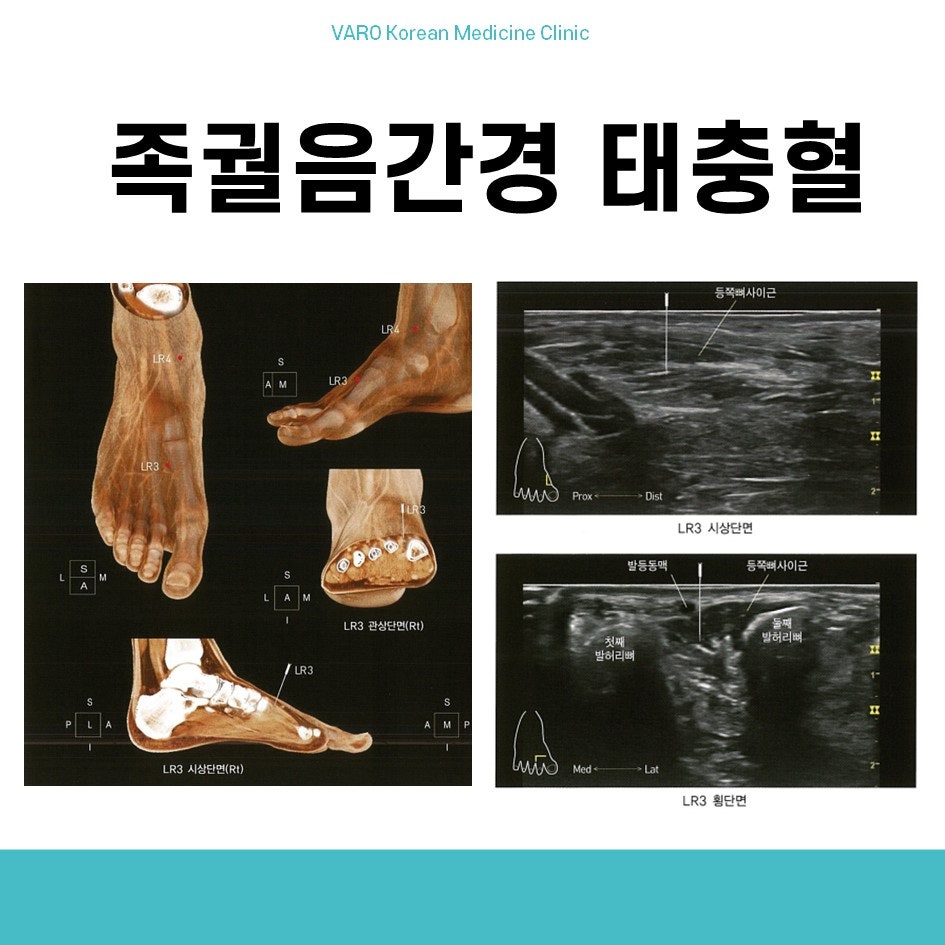 발의 해부학적 구조와 태충혈(LR3) 위치를 보여주는 그림 및 태충혈 주변의 초음파 영상