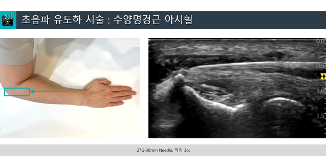팔꿈치에 초음파 유도 침 시술을 하는 모습과 해당 부위의 초음파 영상