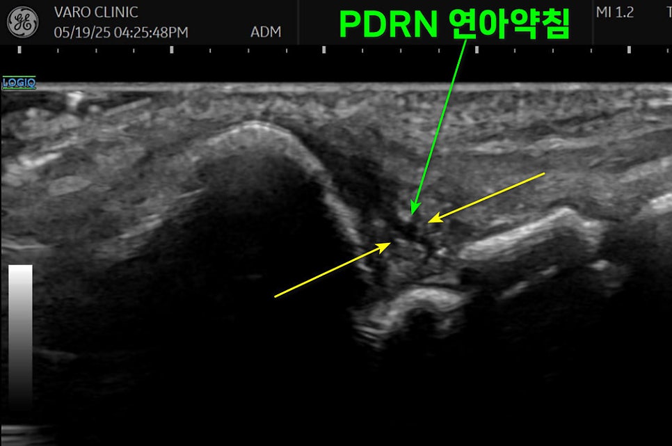 PDRN 연아약침을 TFCC 주변부에 주입하는 초음파 영상