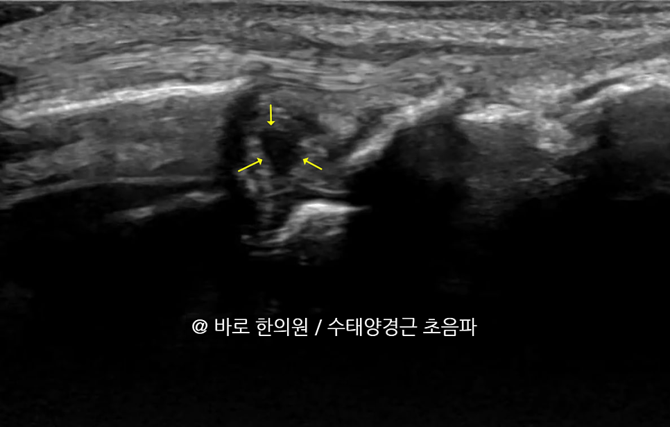 손목 삼각섬유연골복합체(TFCC) 부위의 초음파 영상에 노란색 화살표가 표시되어 있습니다.