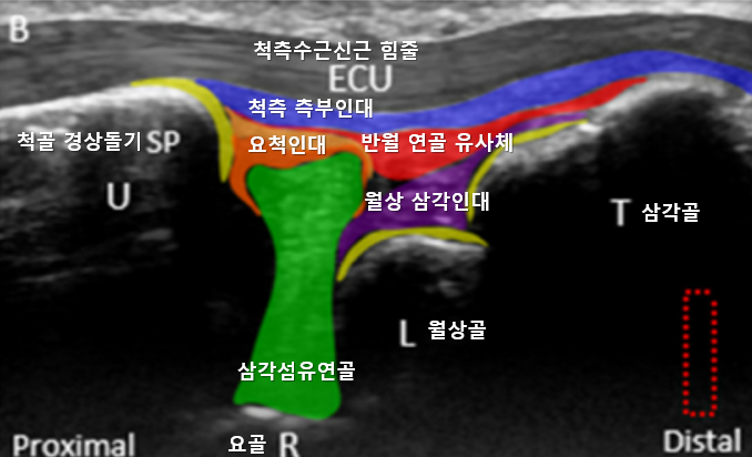 손목 삼각섬유연골복합체와 주변 인대, 뼈를 보여주는 초음파 사진