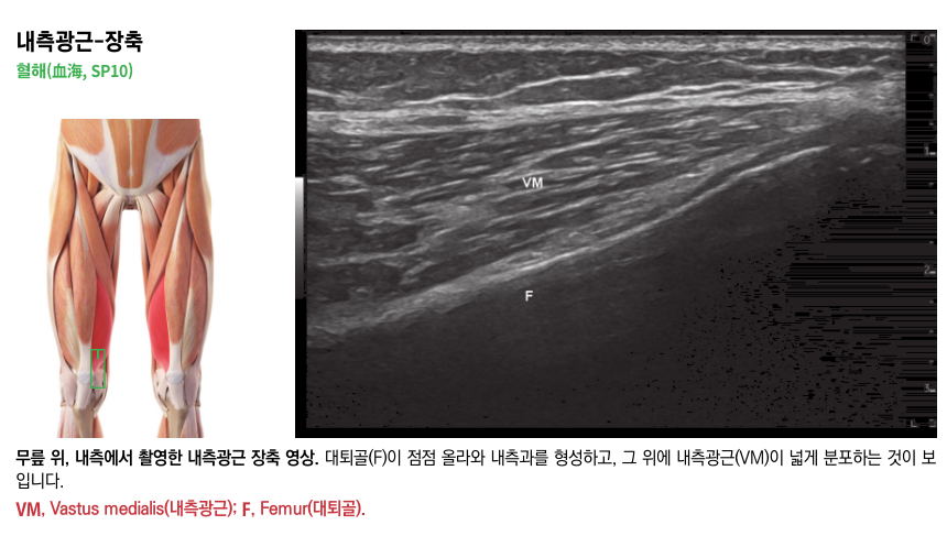 허벅지 근육 해부도와 무릎 위 내측에서 촬영한 내측광근 장축 초음파 영상 — 초음파 정밀 진단 | 서울 바로한의원 초음파 약침·도침·침도