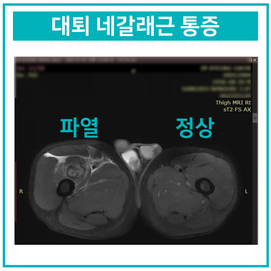 대퇴 네갈래근 파열 부위와 정상 부위를 비교한 허벅지 MRI 사진