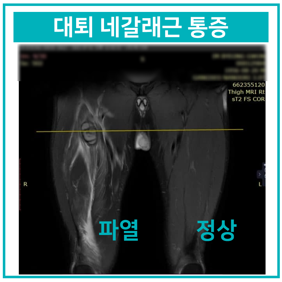 대퇴 네갈래근 통증을 보여주는 허벅지 MRI 사진으로, 왼쪽 허벅지는 파열된 상태이고 오른쪽 허벅지는 정상 상태이다.