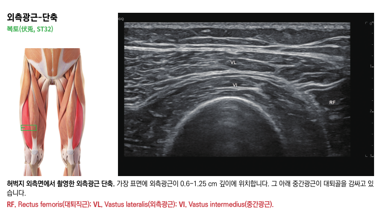 허벅지 외측광근의 해부학적 위치를 나타내는 그림과 해당 부위의 초음파 영상