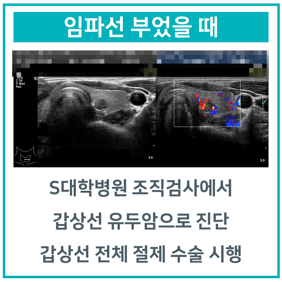 갑상선 유두암 진단과 수술 내용을 설명하는 흑백 및 컬러 도플러 초음파 사진.