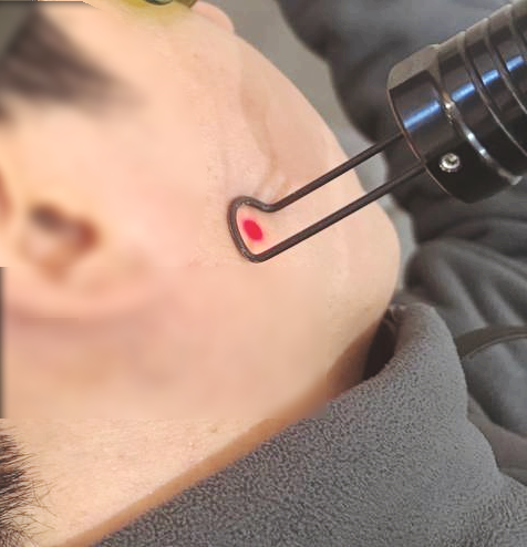 턱 부위에 힐트레이저 치료를 받는 사람의 모습
