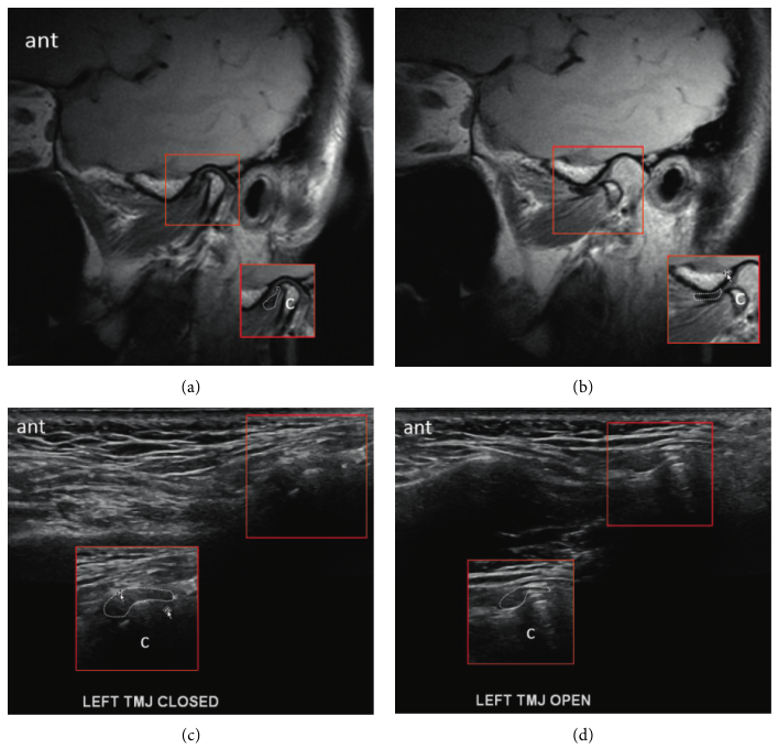 턱관절의 닫힌 상태와 열린 상태를 보여주는 MRI 및 초음파 영상