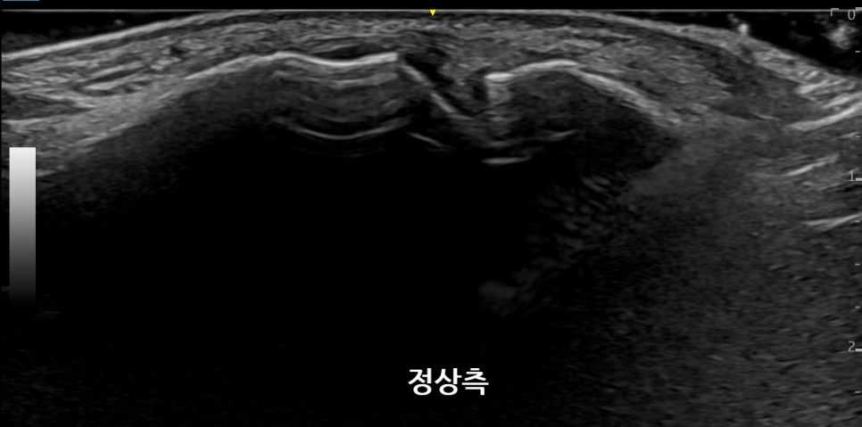 발가락의 정상적인 내부 구조를 보여주는 초음파 사진