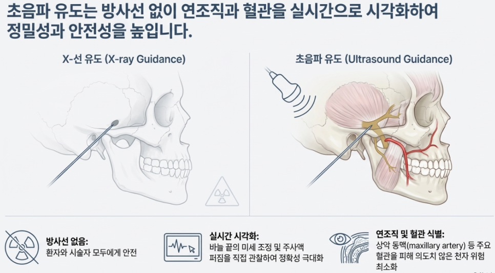 엑스레이 유도와 초음파 유도를 비교하는 그림으로, 초음파 유도 시 삼차신경 부위의 연조직, 신경, 혈관을 보며 주사 바늘이 삽입되는 모습을 보여줍니다.