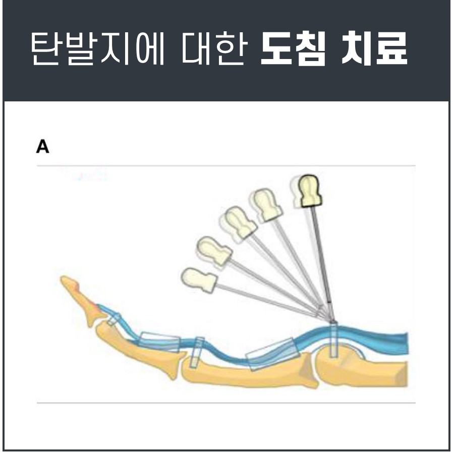 방아쇠 수지 증후군 치료를 위해 손가락 힘줄에 도침을 시술하는 그림