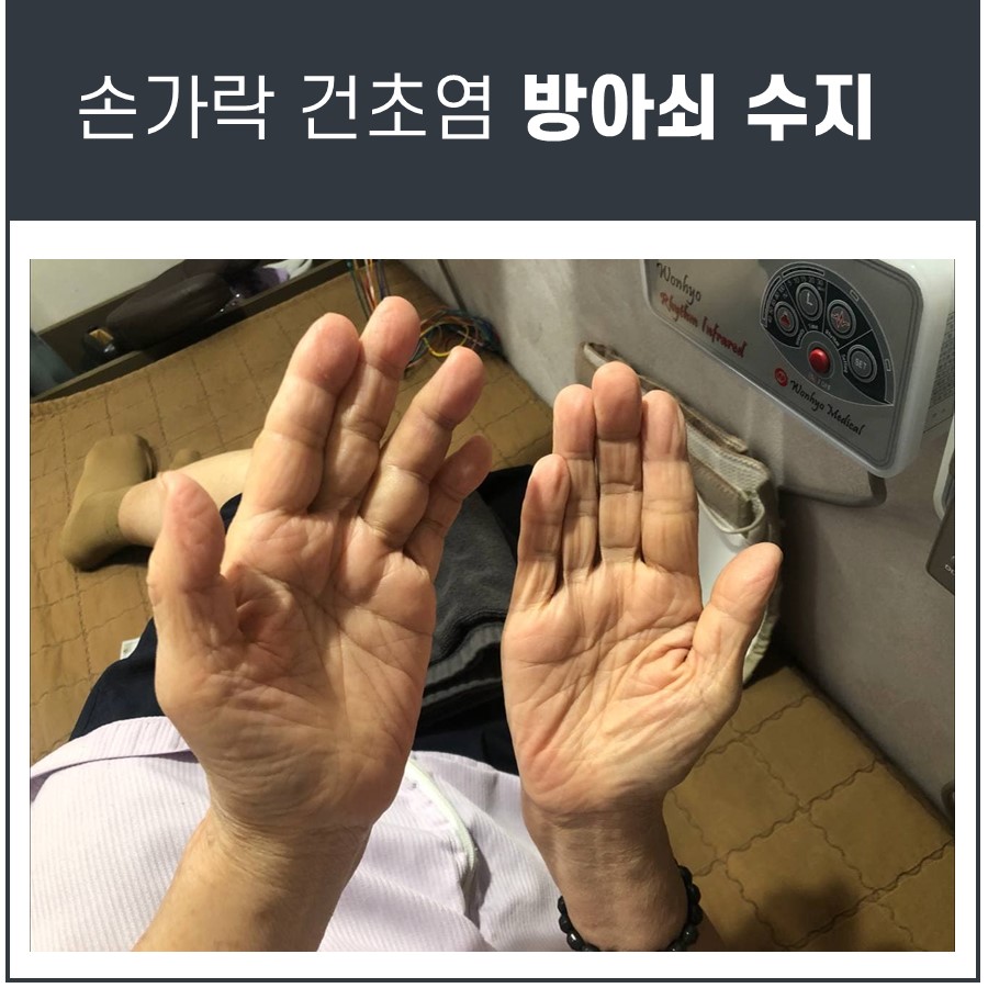 환자의 두 손바닥을 위로 향하게 하여 찍은 사진으로, 손바닥에 주름이 보인다.