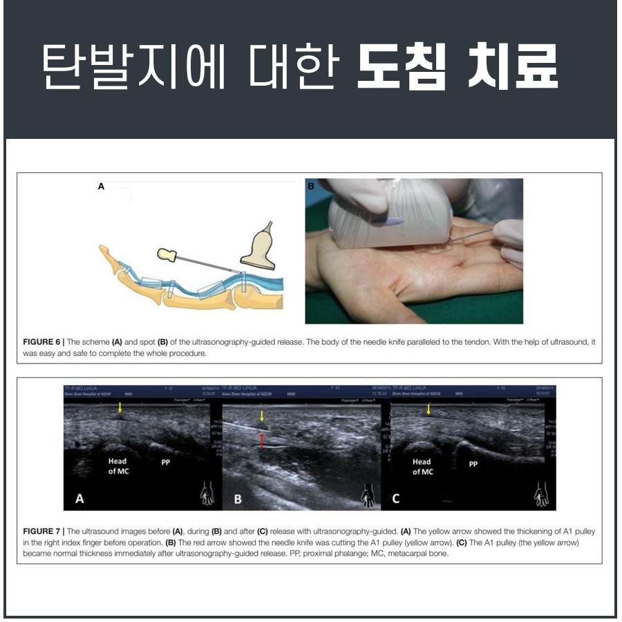 초음파 유도하에 도침으로 방아쇠 수지를 치료하는 과정의 도식과 실제 시술 사진, 그리고 시술 전후 및 시술 중 A1 활차를 절개하는 초음파 영상