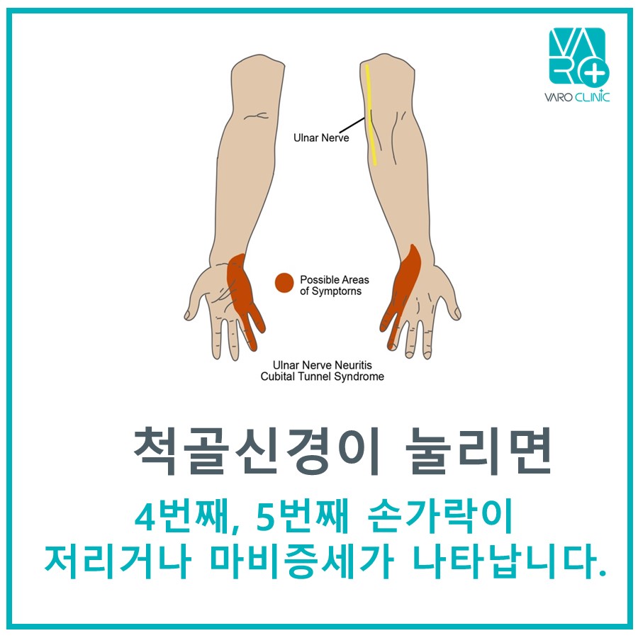 척골신경의 경로와 척골신경 압박 시 4, 5번째 손가락에 나타나는 저림 증상 부위를 보여주는 그림