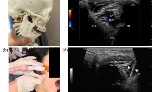 얼굴 모형, 얼굴 근육 초음파 영상, 침 치료 시술 장면, 그리고 침이 삽입된 초음파 영상이 함께 있는 사진.