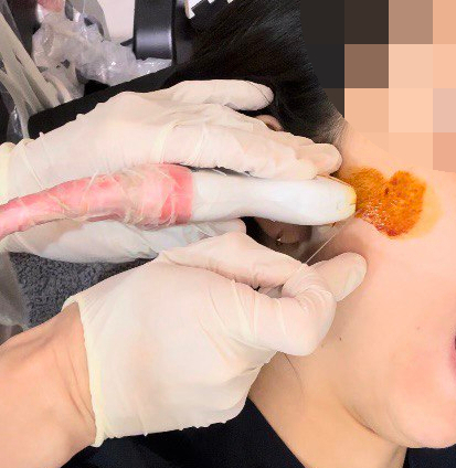 환절기 알레르기 비염 콧물 코막힘 침 치료? <이것> 모르시면 안됩니다 - 초음파 도침 한의원