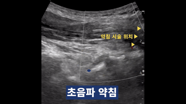 약침 시술 위치를 표시한 초음파 영상