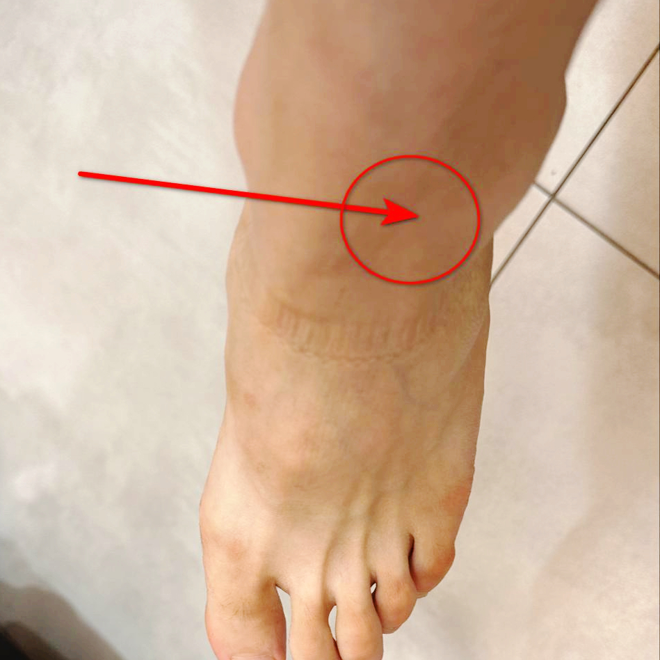 발과 발목 부위를 찍은 사진으로, 빨간 화살표가 발목 위쪽 한 지점을 가리키고 있다.