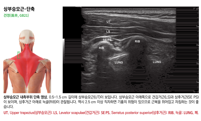 상부 승모근 해부도와 해당 부위의 초음파 영상이 함께 있는 이미지로, 초음파 영상에는 승모근, 견갑거근, 상후거근, 늑골, 폐가 표시되어 있다.
