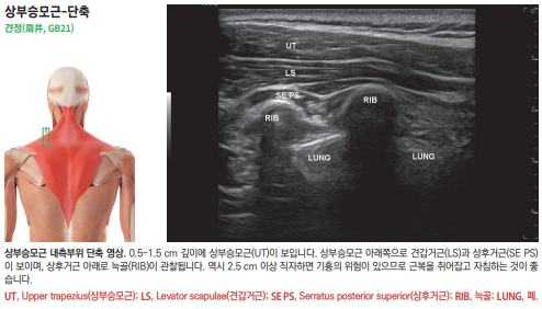 상부 승모근 해부도와 목 부위 초음파 영상