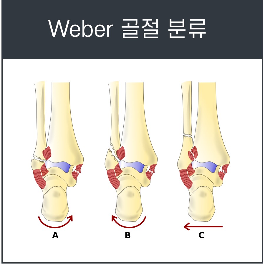발목 비골 골절의 Weber 분류에 따른 A, B, C 세 가지 유형을 보여주는 그림