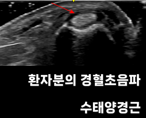 손목 부위의 경혈 초음파 사진으로, 붉은 화살표가 특정 구조물을 가리키고 있다.
