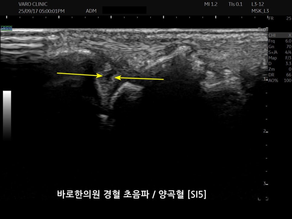 손목 경혈 부위의 초음파 영상으로, 노란색 화살표가 특정 지점을 표시하고 있다.