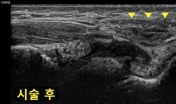 시술 후 손목 부위의 초음파 사진으로, 노란색 화살표가 조직을 표시하고 있습니다.
