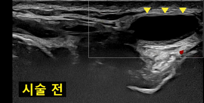 시술 전 손목 결절종 초음파 사진
