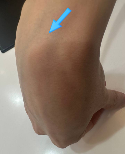 손목 부위에 파란 화살표가 가리키는 융기
