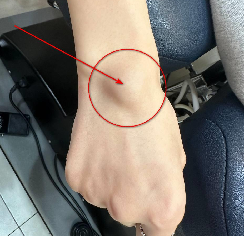 손목 등 쪽에 붉은 원과 화살표로 표시된 결절종이 있는 모습