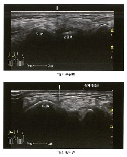 손목 결절종에 침이 삽입된 초음파 사진