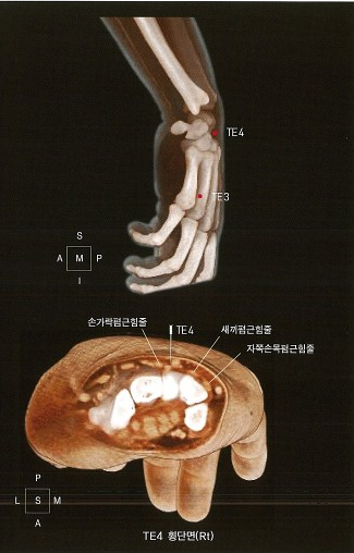 오른쪽 손목과 손의 뼈를 측면에서 본 3D 이미지와 TE4 지점의 횡단면 이미지. 횡단면에는 뼈와 손가락폄근힘줄, 새끼폄근힘줄, 자쪽손목폄근힘줄이 표시되어 있다.