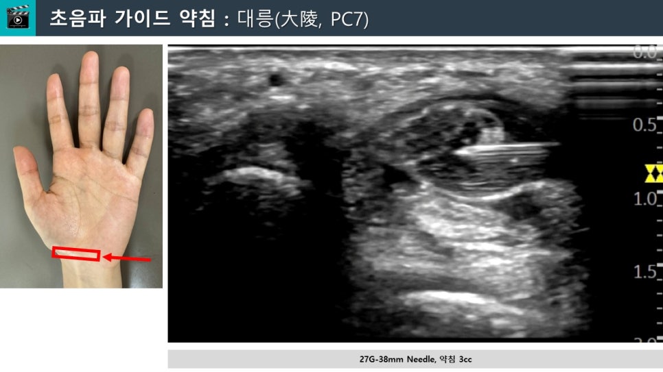 손목의 대릉(PC7) 혈자리에 초음파 유도하에 약침 시술을 하는 모습 — 초음파 유도하 약침 시술 | 서울 바로한의원
