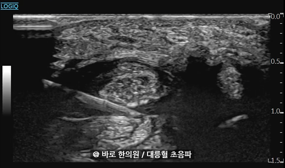 손목 부위의 초음파 영상에서 조직 내에 삽입된 주사 바늘이 보인다.