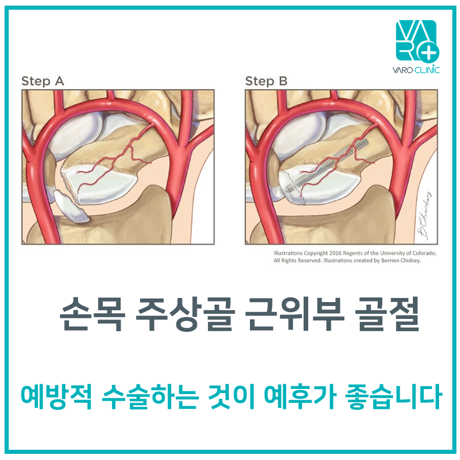 손목 주상골 골절 전후를 보여주는 삽화로, 골절된 뼈와 혈관, 그리고 나사로 고정된 수술 후 모습이 단계별로 묘사되어 있다.