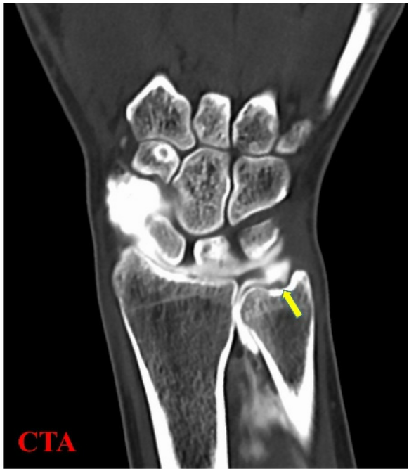 손목 뼈 구조를 보여주는 CT 스캔 이미지이며, 노란색 화살표가 손목의 척골 부위를 가리키고 있습니다.