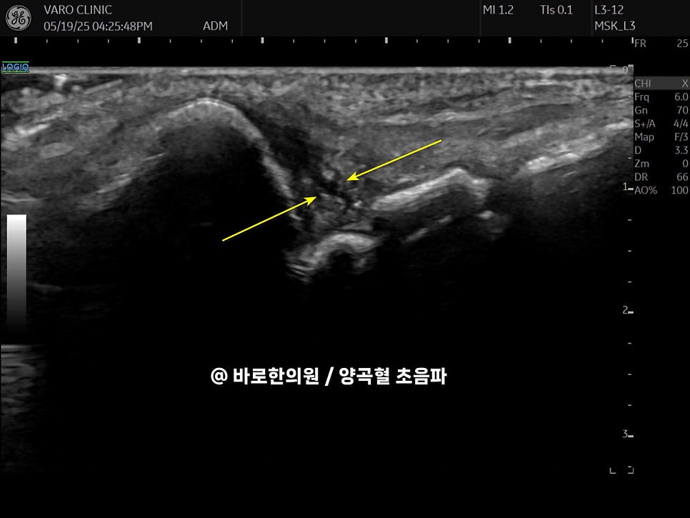 손목 삼각섬유연골(TFCC) 부위를 가리키는 노란색 화살표가 있는 초음파 사진