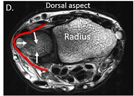 손목의 등쪽을 촬영한 MRI 사진으로, 요골이 표시되어 있고 척골과 손목뼈 사이의 특정 부위에 붉은 선과 흰색 화살표가 있습니다.