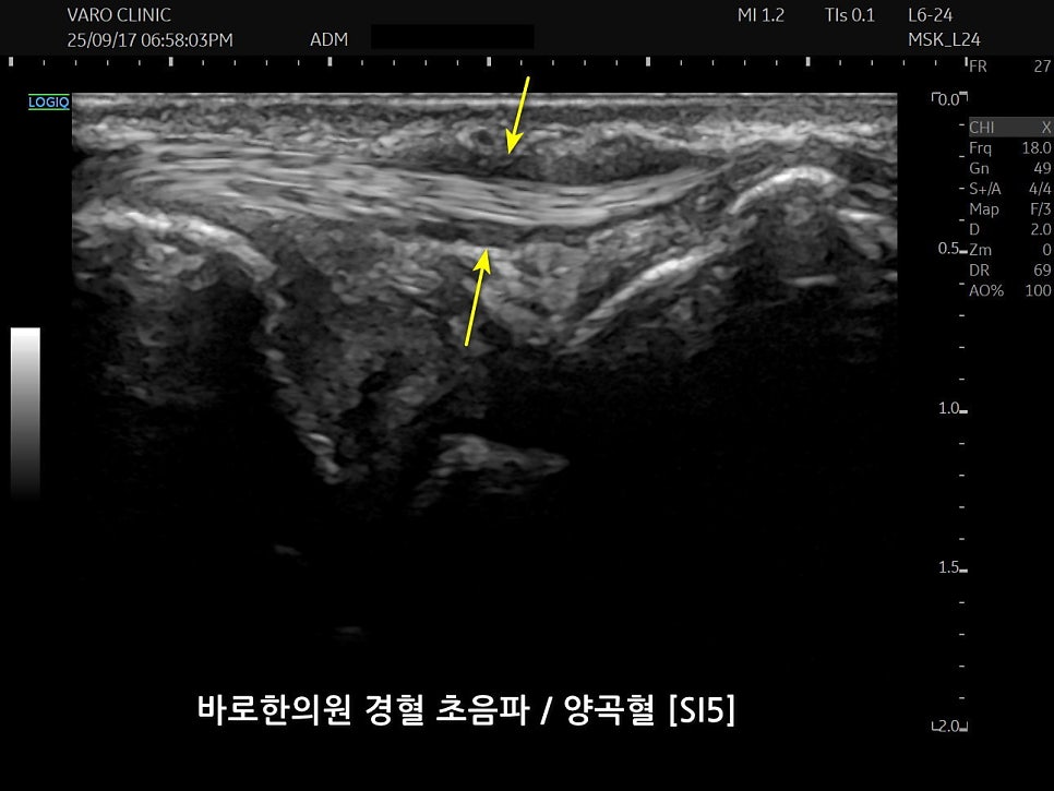 손목 척측 양곡혈(SI5) 부위의 초음파 영상으로, 노란색 화살표가 특정 구조를 가리키고 있다.